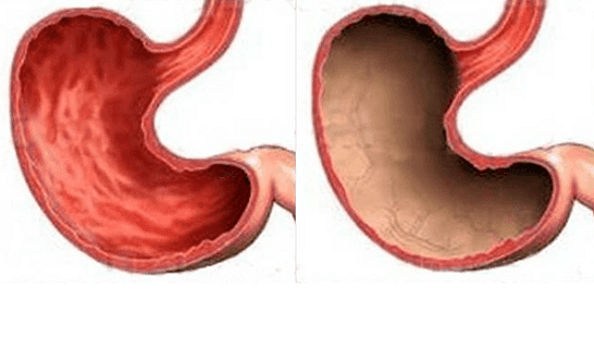 Ulcera, gastrite, cancro e altre patologie dello stomaco (a destra), il cui aspetto era causato dall'alcol