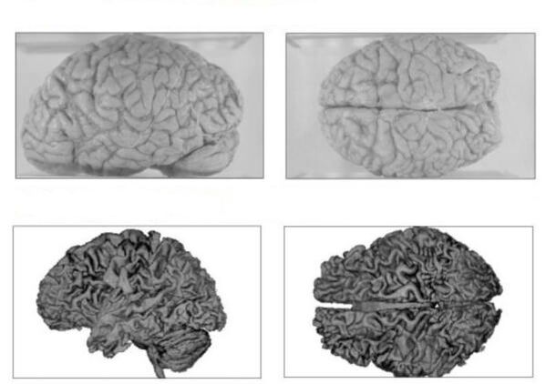 Il cervello di una persona sana (in alto) e il cervello di un alcolizzato con conseguenze irreversibili (in basso)
