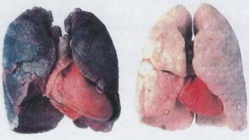 Molti alcolisti cronici muoiono a causa di danni ai polmoni (a sinistra)